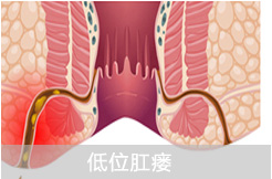 低(dī)位肛瘘