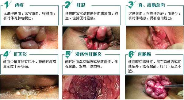 便血六大(dà)常見(jiàn)疾病