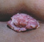 肛門(mén)尖銳濕疣