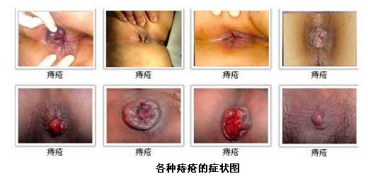 痔瘡實例圖