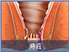 痔瘡