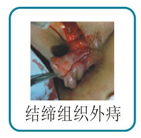 結締組織外(wài)痔