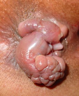 肛乳頭liu實例圖