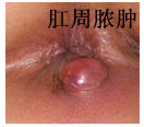 肛周膿腫