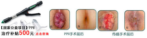 pph微(wēi)創術(shù)