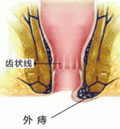 外(wài)痔