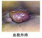血栓外(wài)痔