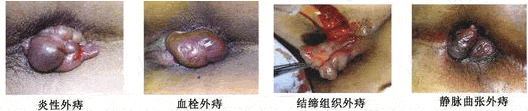 外(wài)痔類型