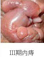 三期內(nèi)痔