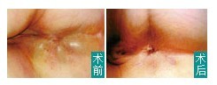 肛周膿腫術(shù)前術(shù)後圖
