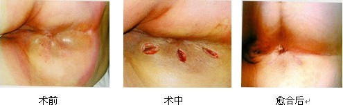 肛周膿腫術(shù)前術(shù)後對(duì)比