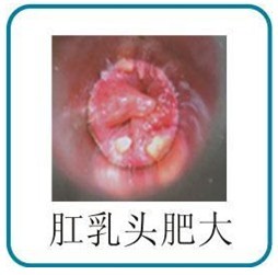 肛乳頭肥大(dà)