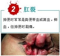 肛裂出血