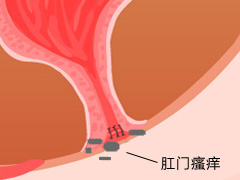 肛門(mén)瘙癢