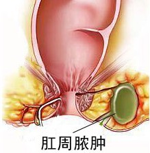 肛周膿腫