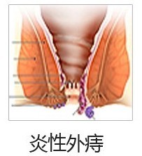 炎性外(wài)痔