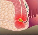形成肛瘘
