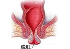 什(shén)麽是(shì)脫肛?